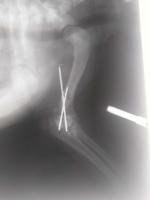 关节肘头与冠状骨斜骨折。经两个小时手术，将断骨联结